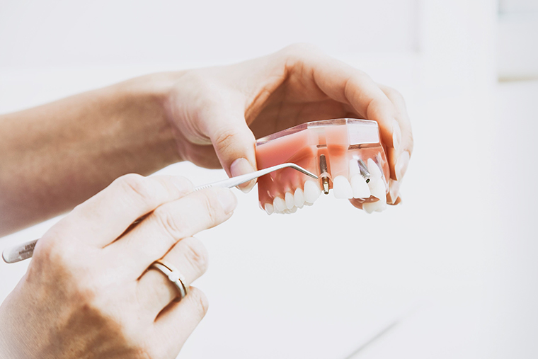 Reabilitação oral: como restaurar a saúde e beleza dos seus dentes